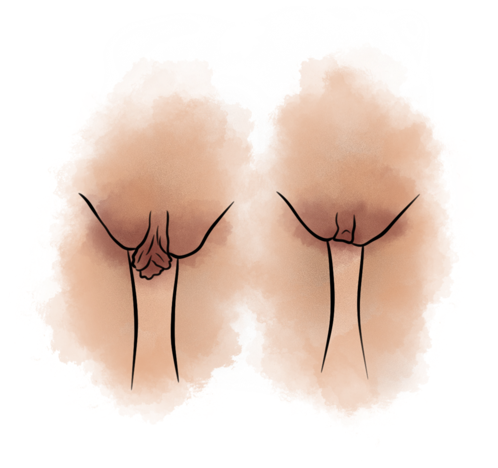 Hipertrofia Grau III