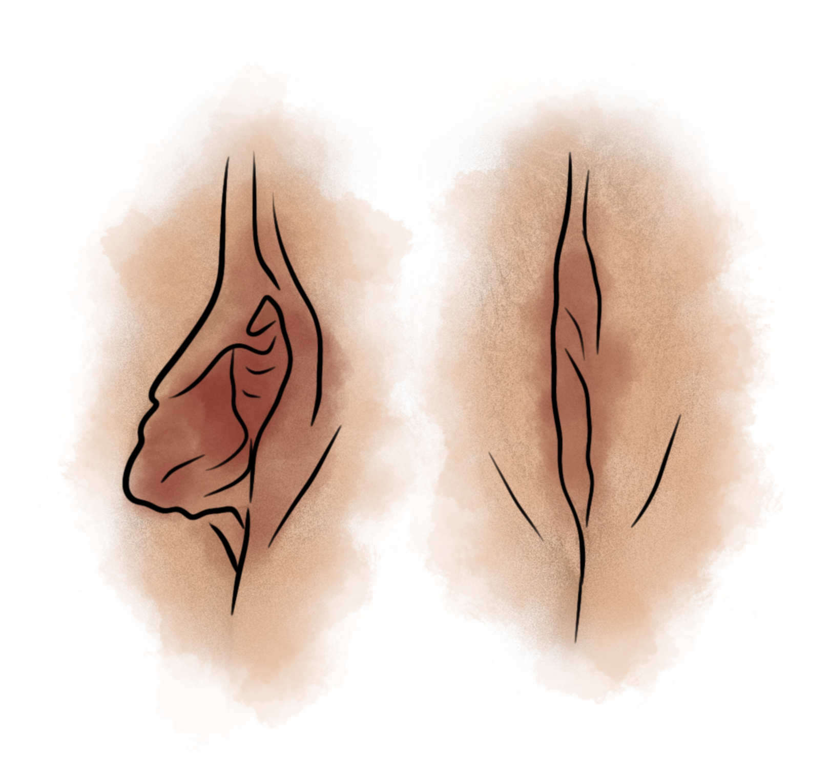 Hipertrofia Unilateral Grau II