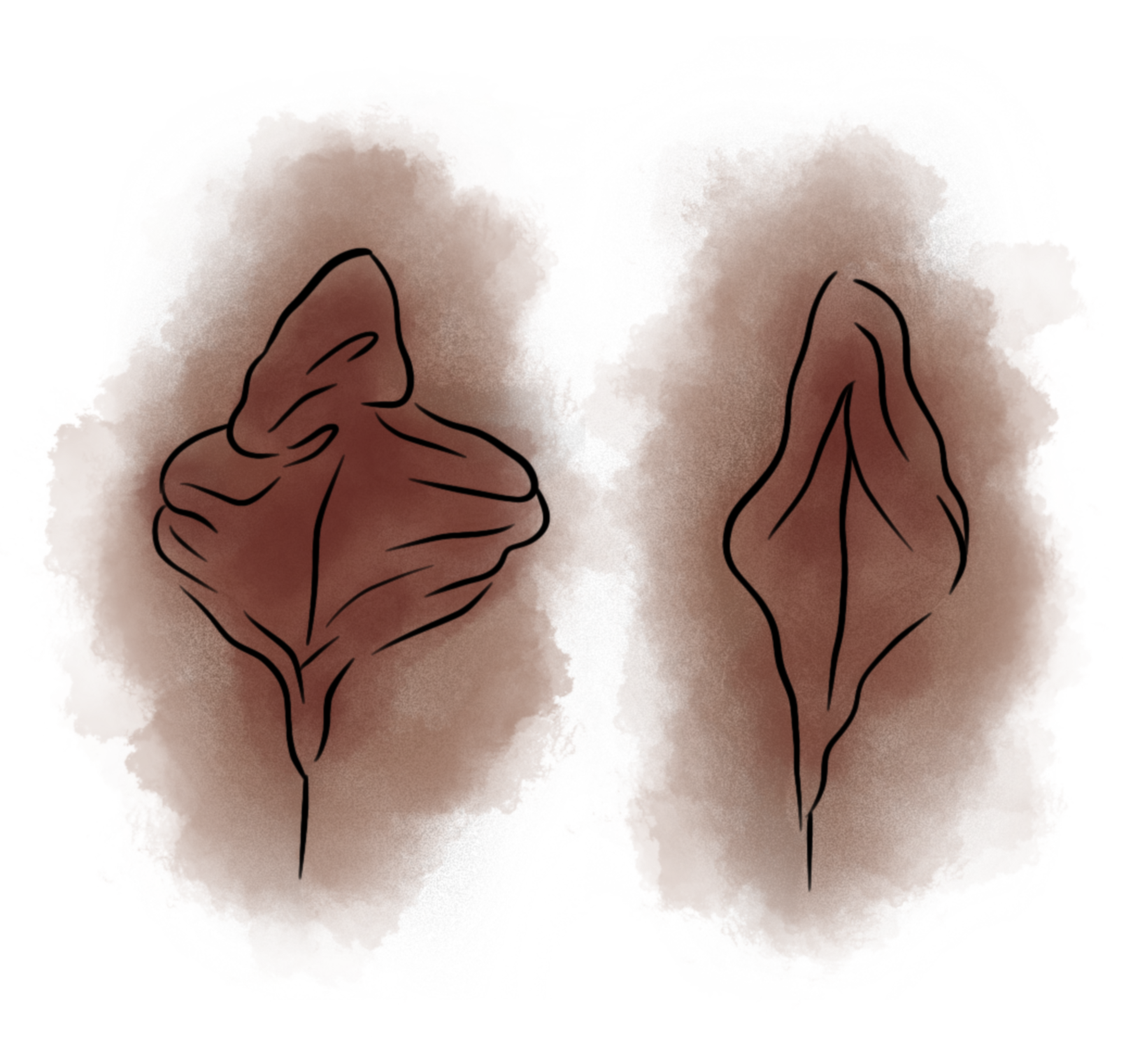 Hipertrofia Grau III